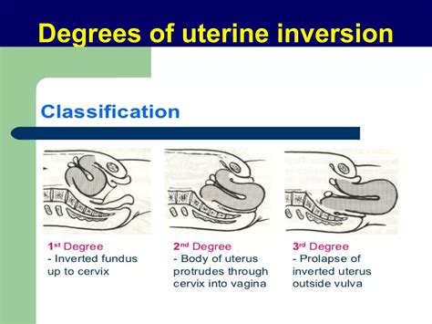 Retroverted retroflexed uterus &uterine inversion | PPT
