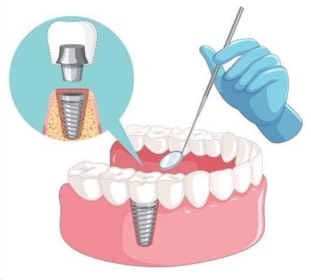 What are the problems with dental implants? Do you know its price in ...