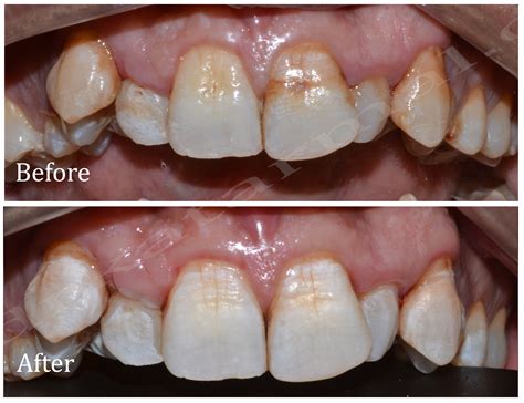 Dental Bleaching for Fluorosis Stains – A Confident New Smile ~ Dr. Bharat Katarmal Dental ...