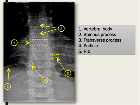 PPT - RADIOLOGICAL ANATOMY OF THE VERTEBRAE PowerPoint Presentation ...