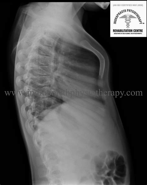 INDRAPRASTH PHYSIOTHERAPY CENTRE: PIGEON CHEST (PECTUS CARINATUM)
