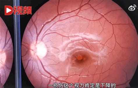 深圳9岁孩子玩激光笔 致左眼视网膜断裂