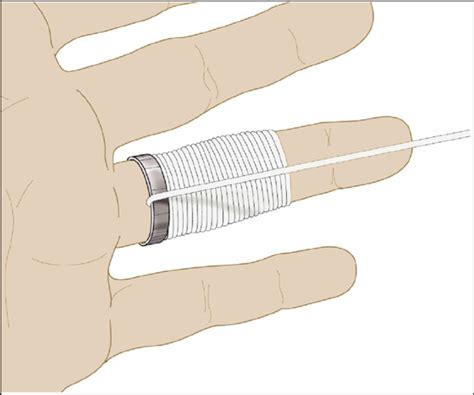 Image result for Ring Removal String Technique