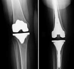 Dr.Kailash Patil | Knee Replacement Specialist Pune| Orthopedic Clinic ...
