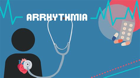 Arrhythmia Definition 的图像结果