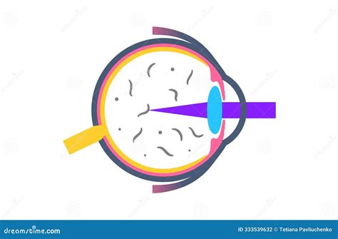 Vitreolysis Laser Treatment Stock Illustration - Illustration of floaters, floater: 333539632