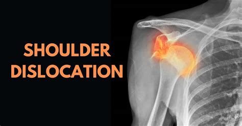 TRAUMATIC SHOULDER DISLOCATION - London Shoulder Surgeon | London Elbow ...