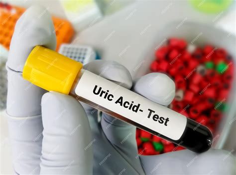 Uric Acid In Blood Test