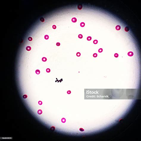 Blood Stream Infection With Yeast Seen Through A Microscope Stock Photo ...
