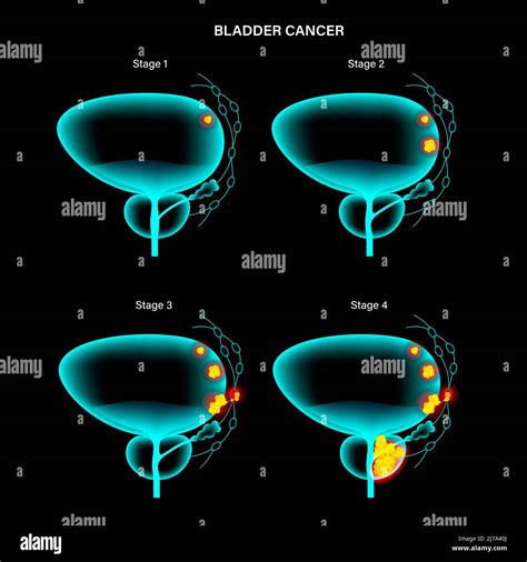 Bladder cancer stages, illustration Stock Photo - Alamy