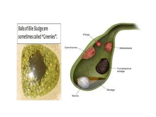 Image result for How to Remove Gallbladder Sludge