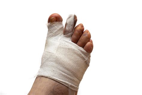 Image result for Toe Surgery