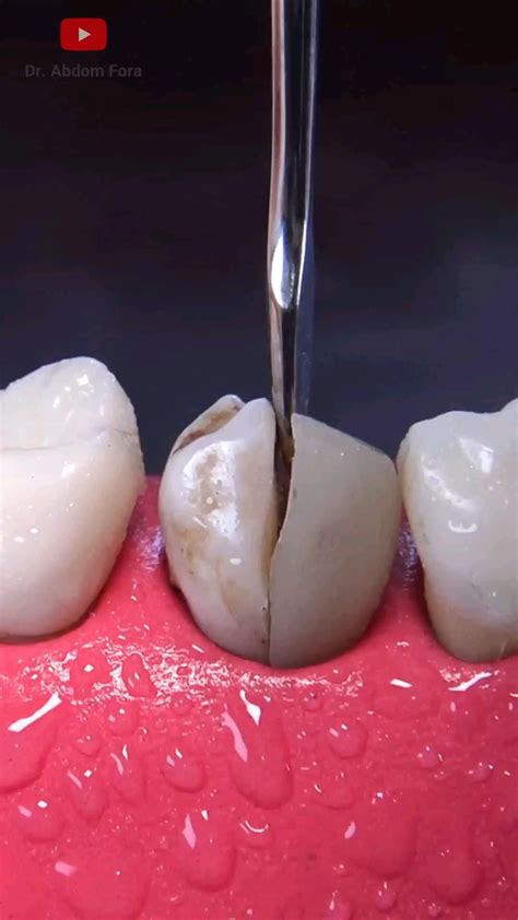 Image result for Root Extraction Tooth Broken Off