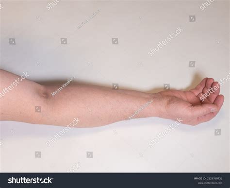 Iv Bruise Back Of Hand