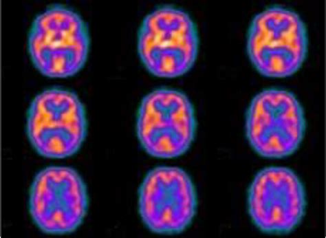 Rezultat imagine pentru Dat Brain Scan