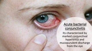Conjunctivitis | PPTX