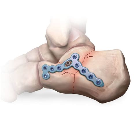 Compression Plate Ankle 的图像结果