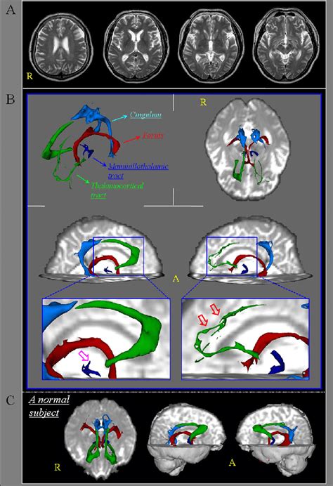 Image result for Diffuse Tensor Imaging