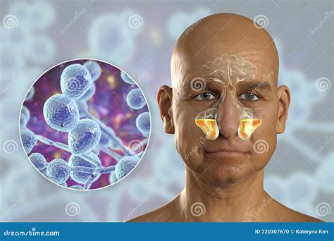 Sinusitis, Inflammation of Paranasal Cavities, 3D Illustration Stock Illustration - Illustration ...
