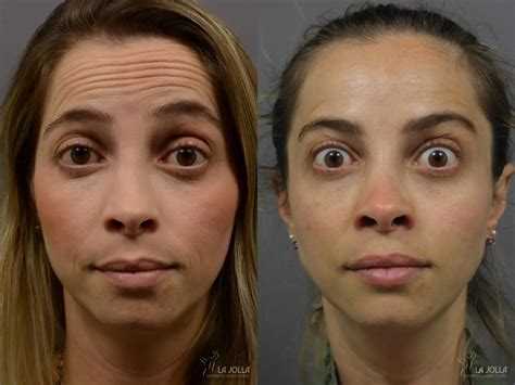 BOTOX® Before & After Gallery