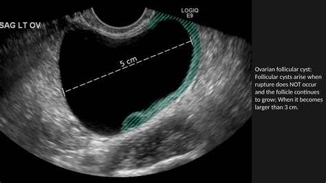 Ovarian Cysts: A Comprehensive Guide to Classification, Clinical Features, Diagnostics, and ...