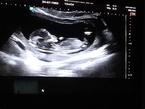 Ultra-som 12 semanas e 6 dias | BabyCenter