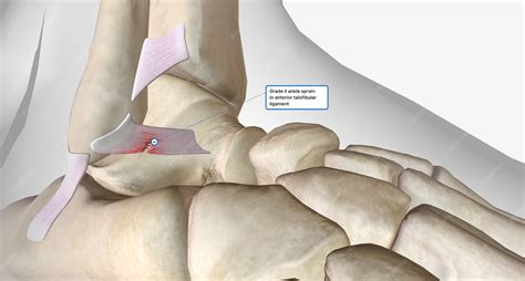 What Is A Full Thickness Tear Of The Anterior Talofibular Ligament at ...