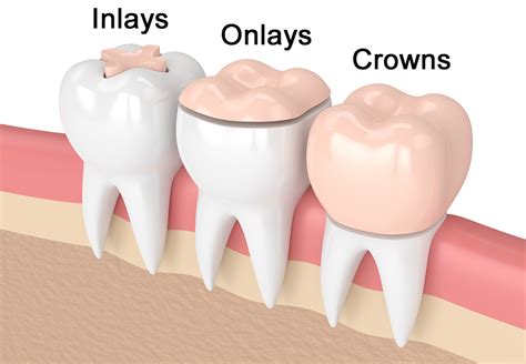 Inlay & Onlays, Dental Clinic AVENTURA, FL