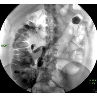 Image result for Retro Pyelogram Cystoscopy