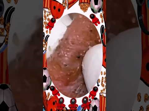 Blackheads Removal #451 | Acne Treatment and Very Satisfying Satisfying Pimple pop #blackheads