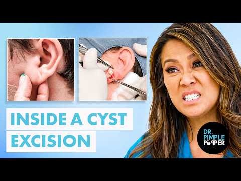 How an Earlobe Cyst Is Surgically Removed | Dr. Pimple Popper