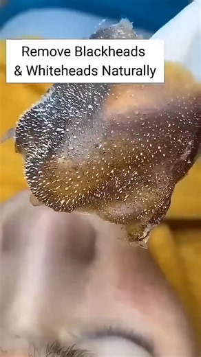 Permanent Blackheads & Whiteheads Removal Tips#shortsfeed#skincare#ytshorts#Whiteheads#blackheads#yt