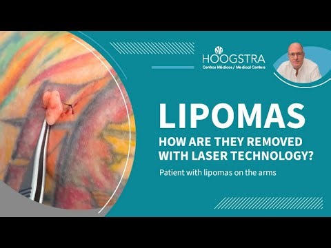 Lipoma removal on arm - 25193