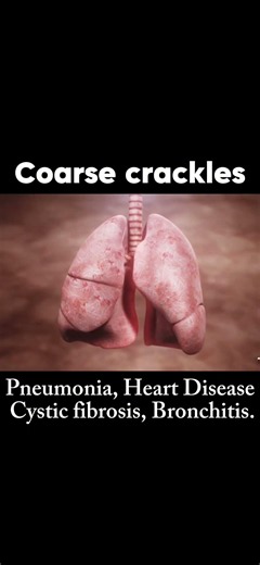 Abnormal Lung sounds which every medical student should learn about in easy steps ! #doctor