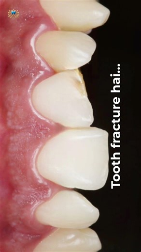 👉 Broken Front Tooth? 😬 See Before & After Smile Repair in Patna