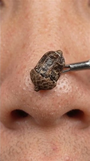 The biggest blackhead on his nose 😳 Giant blackhead removal with a comedone extractor #oddlysat