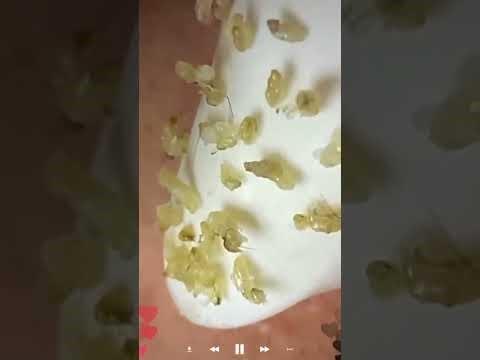 Acne Treatment & Blackhead Removal | Very Satisfying Pimple Popping #225