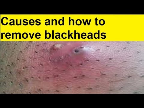 causes and how to remove blackheads