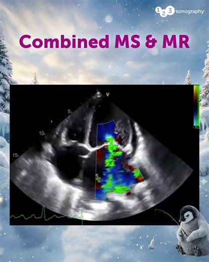 Combined MS & MR 🧐