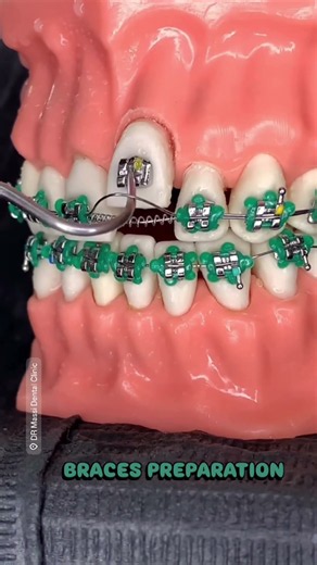 BRACES PREPARATION 😬🦷