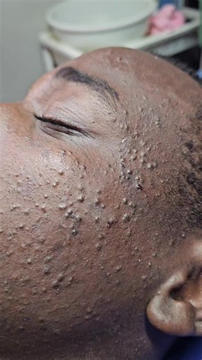Pimple Treatment and Acne Management Facial — Part 5556