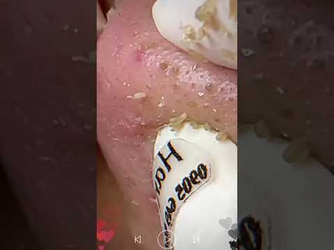 Skincare | Blackheads Removal #852 #tweezers skincare #blackheads blackheads