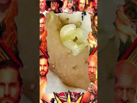 Blackheads Removal | Acne Treatment and Very Satisfying Satisfying Pimple pop #blackheads