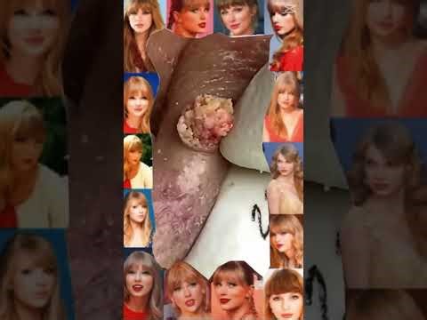 Blackheads Removal #323 | Acne Treatment and Very Satisfying Satisfying Pimple pop #blackheads