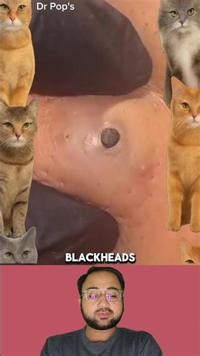 Blackhead Removal Like You've Never Seen Before! #Skincare #shorts