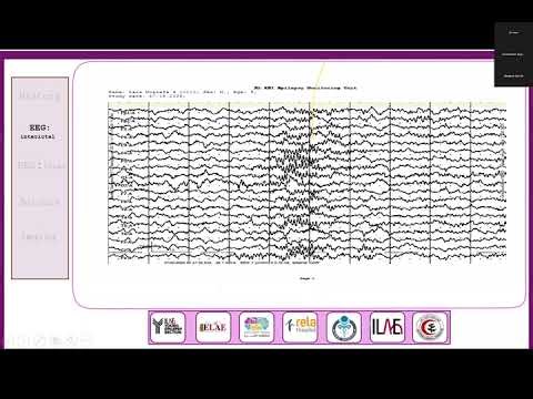 MDT#1-SEEG Case Discussions:Pediatric Mesial‑Frontal & Discordant Temporal Cases SEEG Week