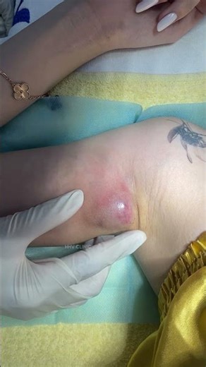 Inflammatory abscess in armpit, painful and unable to lift arm.