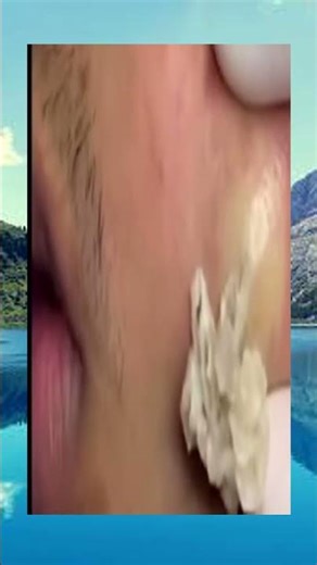 Endless blackhead pops!