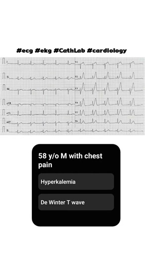 Diagnosis ❓| Is this Hyperkalemia or De Winter T-wave pattern? #ekg #ecginterpretation