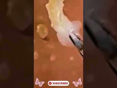 Extreme Blackhead Removal | Deep Pore Cleaning #blackheads